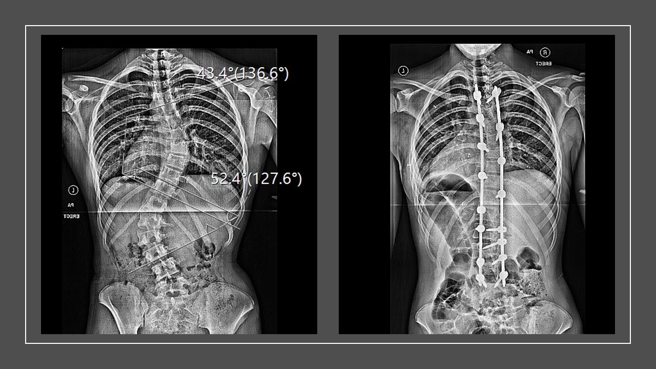 Two x-rays side by side which show Phoebe Grace's spine before surgery with a curve and after surgery with the titanium rods fitted